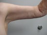 Arm Lift