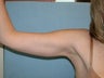 armlift