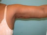 armlift