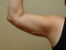 Arm Lift