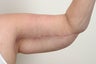 Brachioplasty