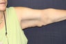 Brachioplasty (Arm Lift)