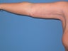 Brachioplasty