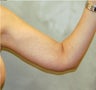 Arm Lift