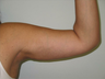 Arm Lift