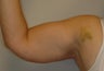 Arm Lift