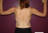 Arm lift