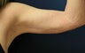 Brachioplasty (Arm lift)