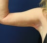 Arm lift (brachioplasty)