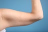 Brachioplasty