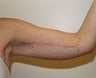 Brachioplasty (Arm Lift)