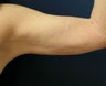 Arm Lift