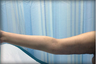 Brachioplasty