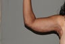 Arm Lift-Brachioplasty