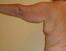 Arm Lift