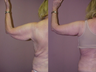 Arm Lift