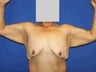 Arm Lift