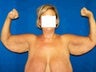 Arm Lift