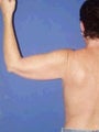 Arm Lift