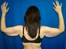Arm Lift