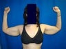 Arm Lift