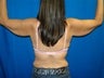 Arm Lift
