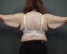 Brachioplasty