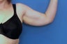Brachioplasty
