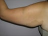 Arm Lift