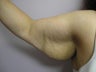 Arm Lift