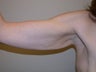 armlift