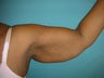 armlift