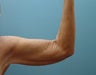 Full Extended Brachioplasty