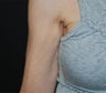 VASER Shape to Arms