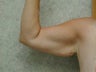 Arm Lift