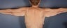 Brachioplasty 