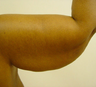 BRACHIOPLASTY (ARM LIFT)