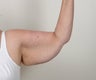 Brachioplasty