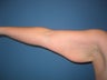 Brachioplasty