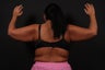 Arm Lift