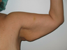 Arm Lift