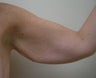 Brachioplasty (arm lift)