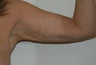 Brachioplasty (Arm lift)