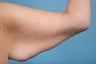 Brachioplasty