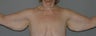 Arm-lift, Brachioplasty