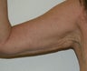 Arm lift
