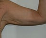 Arm Lift