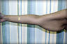 Brachioplasty