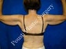 Arm Lift