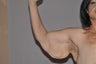 Arm Lift-Brachioplasty